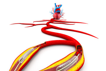Stent angioplasty procedure with placing a balloon