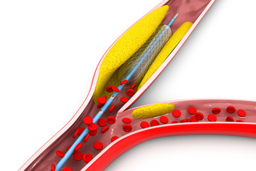 Stent angioplasty procedure with placing a balloon