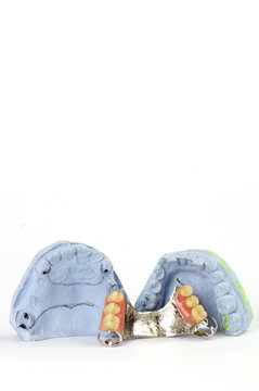 partial denture 4