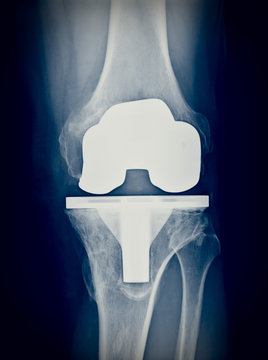 Bicompartmental knee prosthesis xray