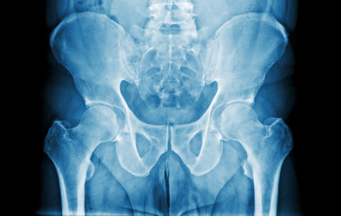 Abdomen X-Ray