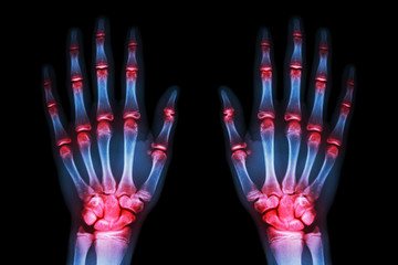multiple joint arthritis both hands ( Gout , Rheumatoid )