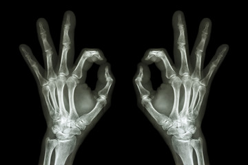 X-ray hands with OK sign