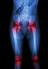 Film x-ray body of child and arthritis at hip and knee