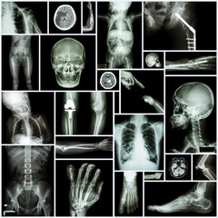X-ray Multiple part of human ,Orthopedic and  Multiple disease