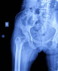 x-ray of hip