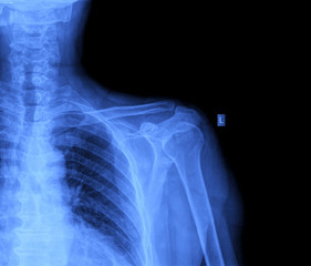 x-ray shoulder