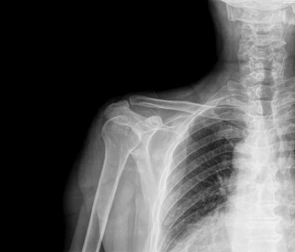 x-ray shoulder
