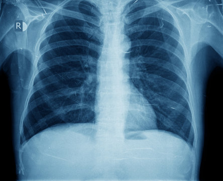 x-ray chest man