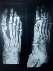 X-ray feet