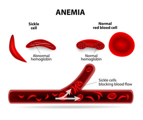anemia - obrazy, fototapety, plakaty