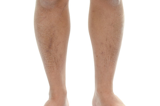 Closeup texture of  bad skin leg