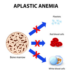 aplastic anemia