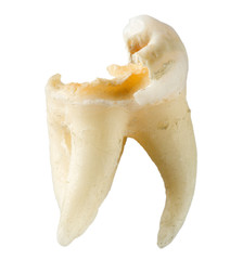 extracted tooth with caries isolated on white background