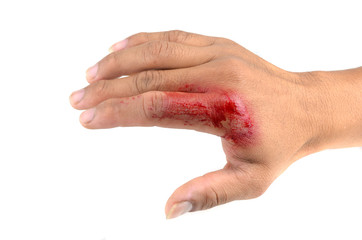 bloody wounds on hand