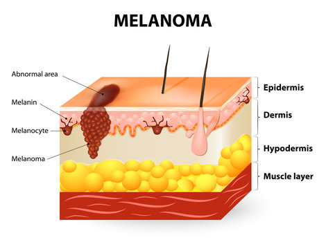 Melanoma or skin cancer