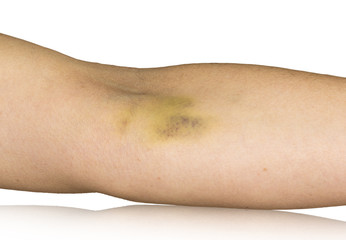 Bruise on hand
