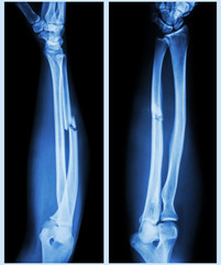 Comminuted fracture shaft of ulnar bone