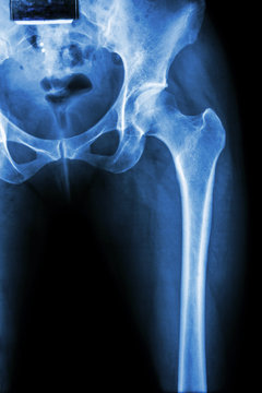 normal pelvis & hip joint