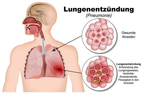 Lungenentzündung, Pneumonie