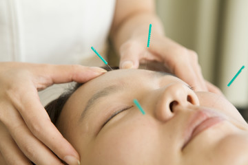 Acupuncture for beauty