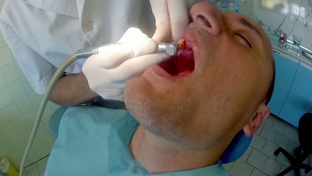 Patient&rsquo;s gum bleeding because of dentist&rsquo;s intervention