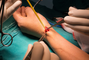 prepare cephalic vein for arteriovenous fistula