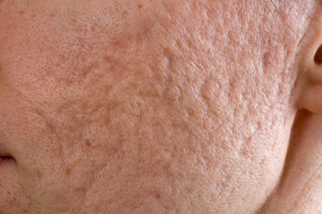 Acne scars on cheek