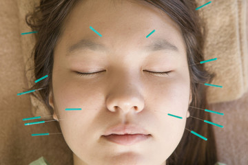 Obraz premium Facial acupuncture