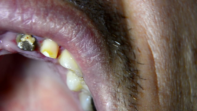 Dental check of teeth prepared for bridge montage