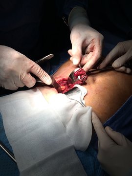 intervento di appendicite