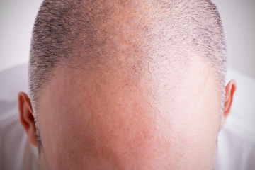 Hair Loss