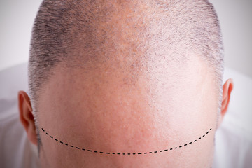 Hair Loss