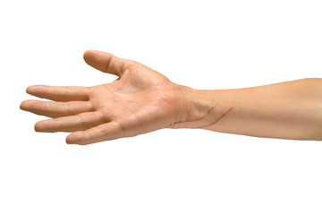 猫の引っ掻き傷