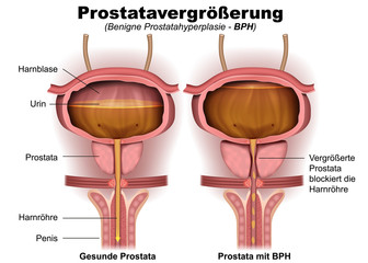 Prostatavergrößerung, BPH, anatomie illustration