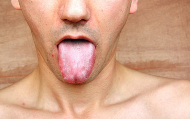 Infection tongue