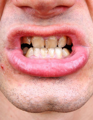 Tartar and tooth decay