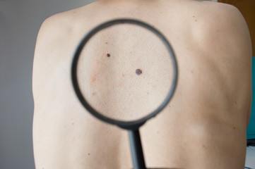 Checking melanoma on the back of a man