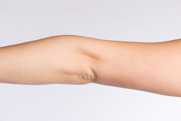 Linker Ellenbogen einer Frau