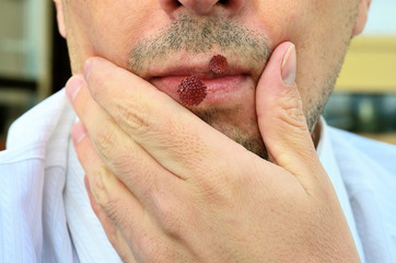 Naklejka premium Herpes simplex
