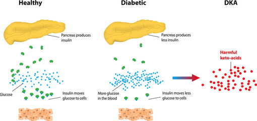 Obraz premium Diabetic Ketoacidosis