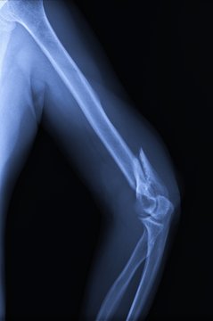 Broken arm / elbow.