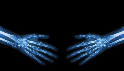 Shake hands .  X-ray normal human hands