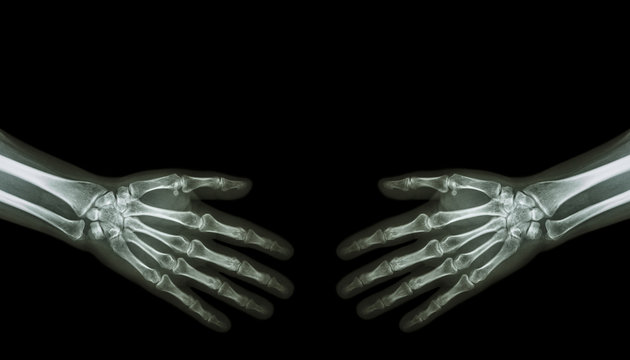 Shake hands .  X-ray normal human hands