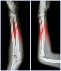 Fracture shaft of ulnar bone ( forearm bone )