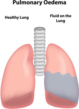 Pulmonary Oedema