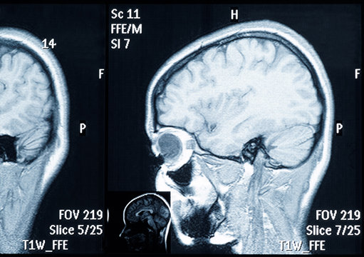 Real brain MRI slide of a young woman