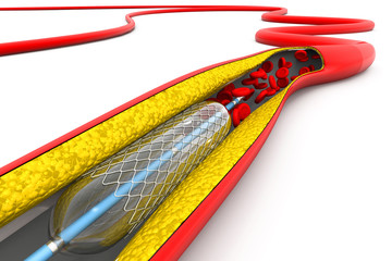 Stent angioplasty procedure with placing a balloon