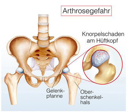 Knorpelschaden am H&uuml;ftkopf