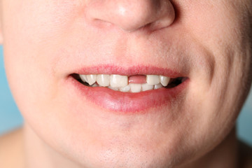 Smile without front tooth